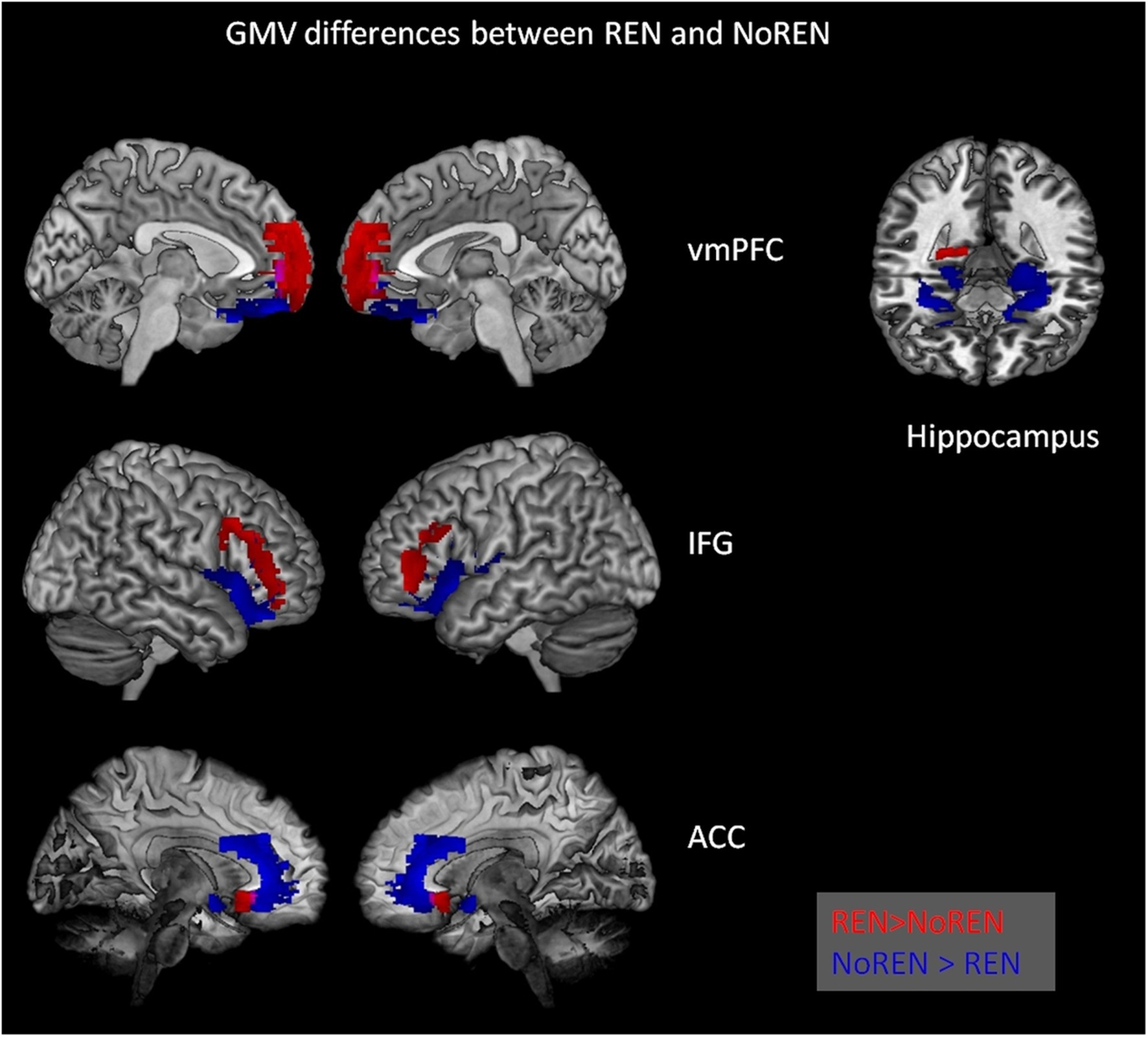 Brain scans showing GMV differences between REN and NoREN groups. Highlighted areas include vmPFC, IFG, and ACC, with red indicating higher GMV in REN and blue in NoREN, alongside a hippocampus cross-section.