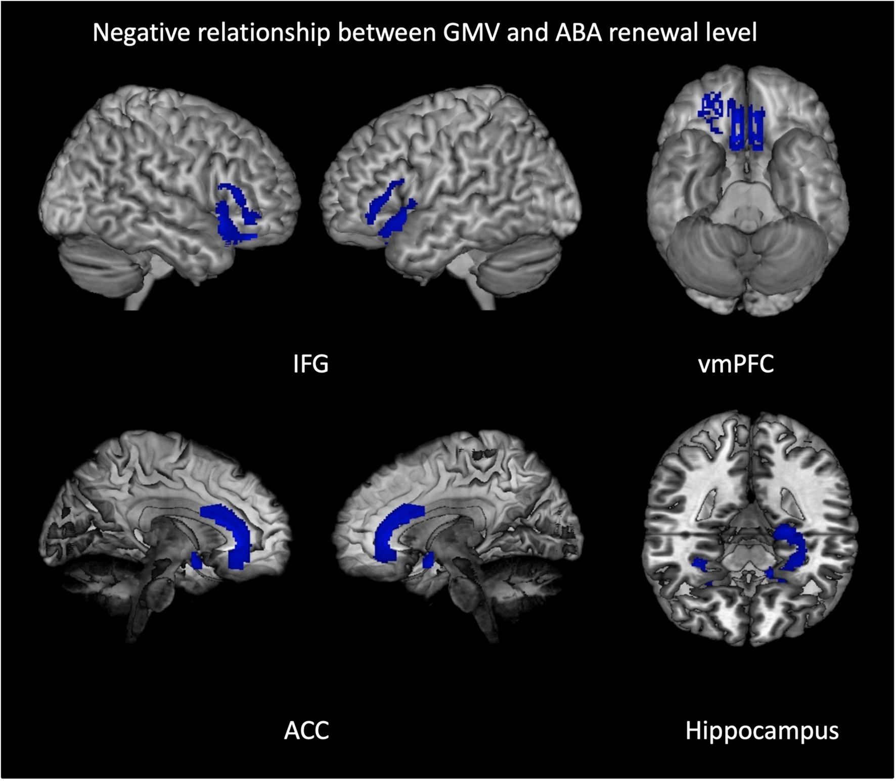 Brain images showing a negative relationship between gray matter volume (GMV) and ABA renewal level, with highlighted areas in blue. The images depict the inferior frontal gyrus (IFG), ventromedial prefrontal cortex (vmPFC), anterior cingulate cortex (ACC), and hippocampus.