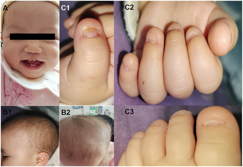 A collage of six images showing features of an infant. Image A displays a smiling baby with a black bar over the eyes. Images B1 and B2 show different angles of sparse hair on the baby’s head. C1, C2, and C3 focus on the digits, highlighting underdeveloped or damaged nails and skin variations on fingers and toes.