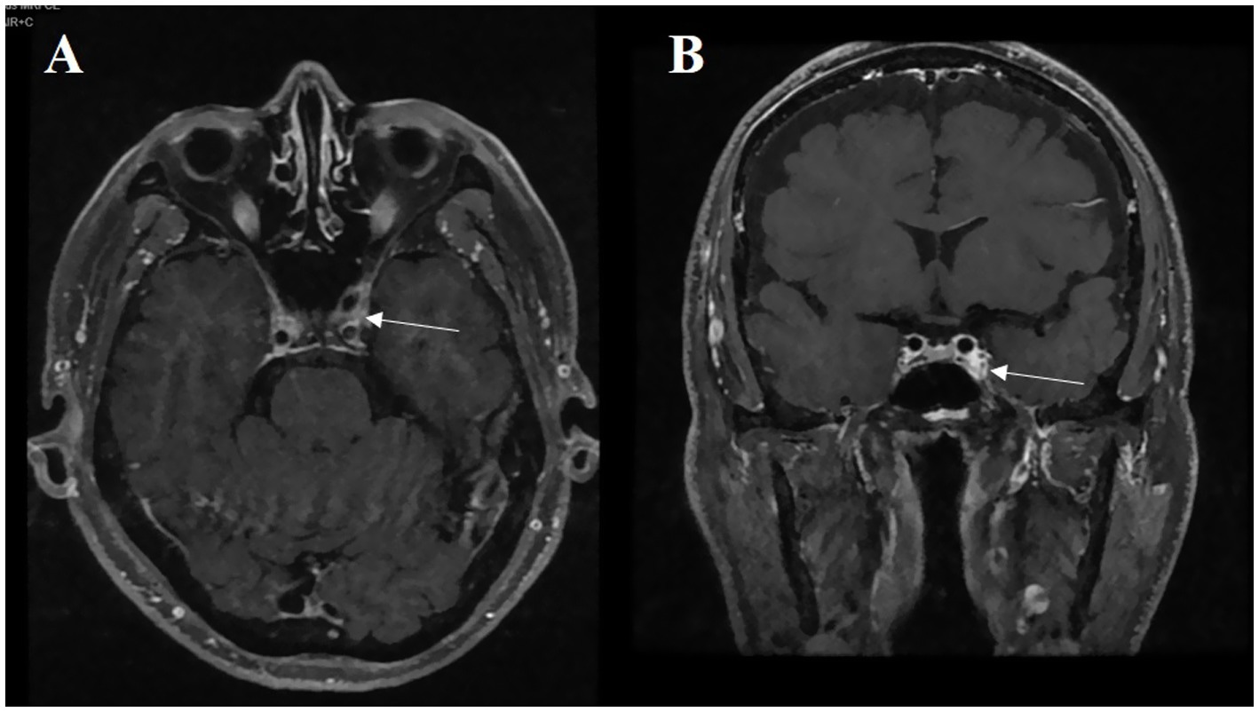 MRI brain scans in two panels labeled A and B. Panel A shows an axial view with an arrow pointing to a region near the center. Panel B displays a coronal view with an arrow indicating a specific area within the brain. Both images appear to focus on a similar anatomical region.