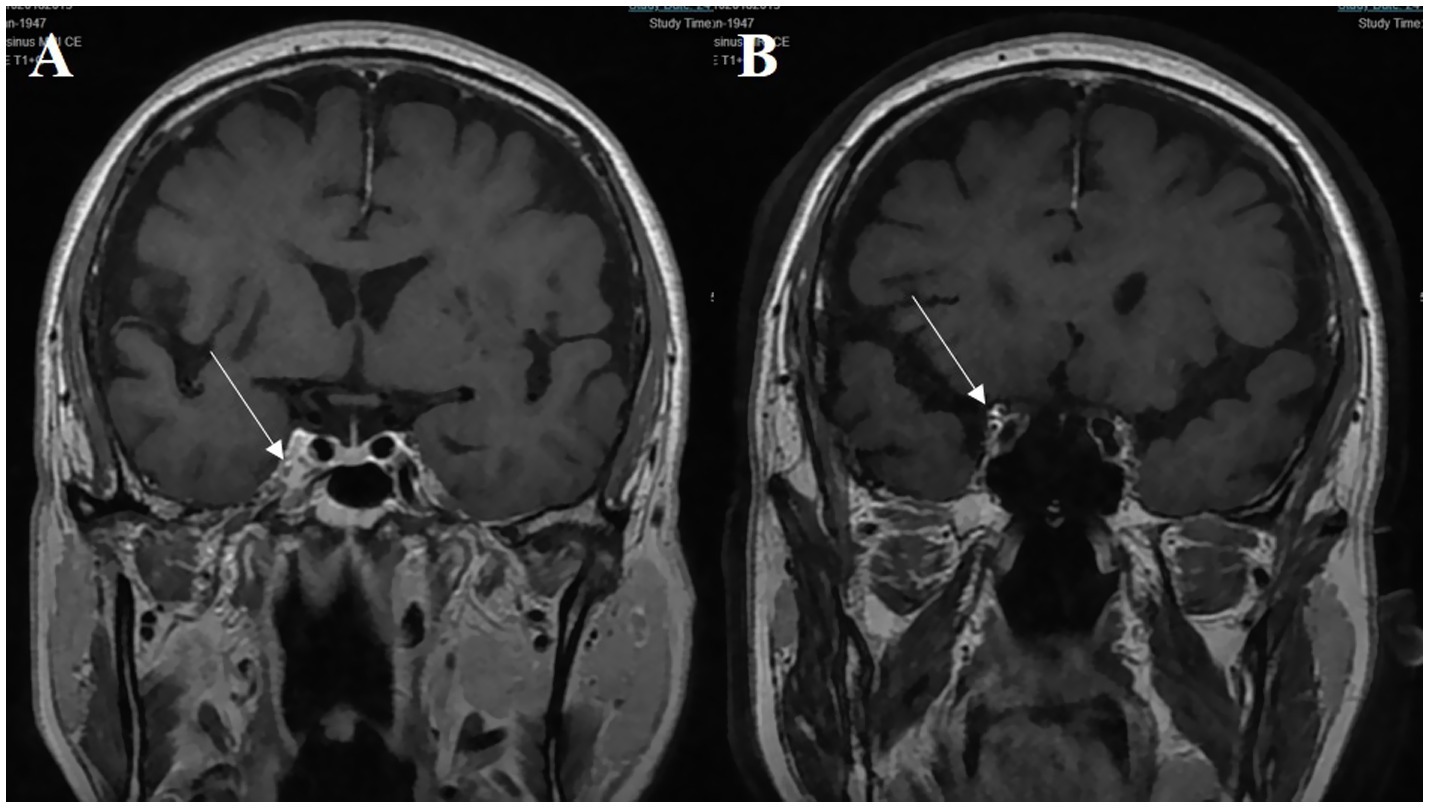MRI scans showing brain cross-sections, marked A and B. Image A has an arrow pointing to an area near the temporal lobe, while image B highlights a similar region on the opposite side.