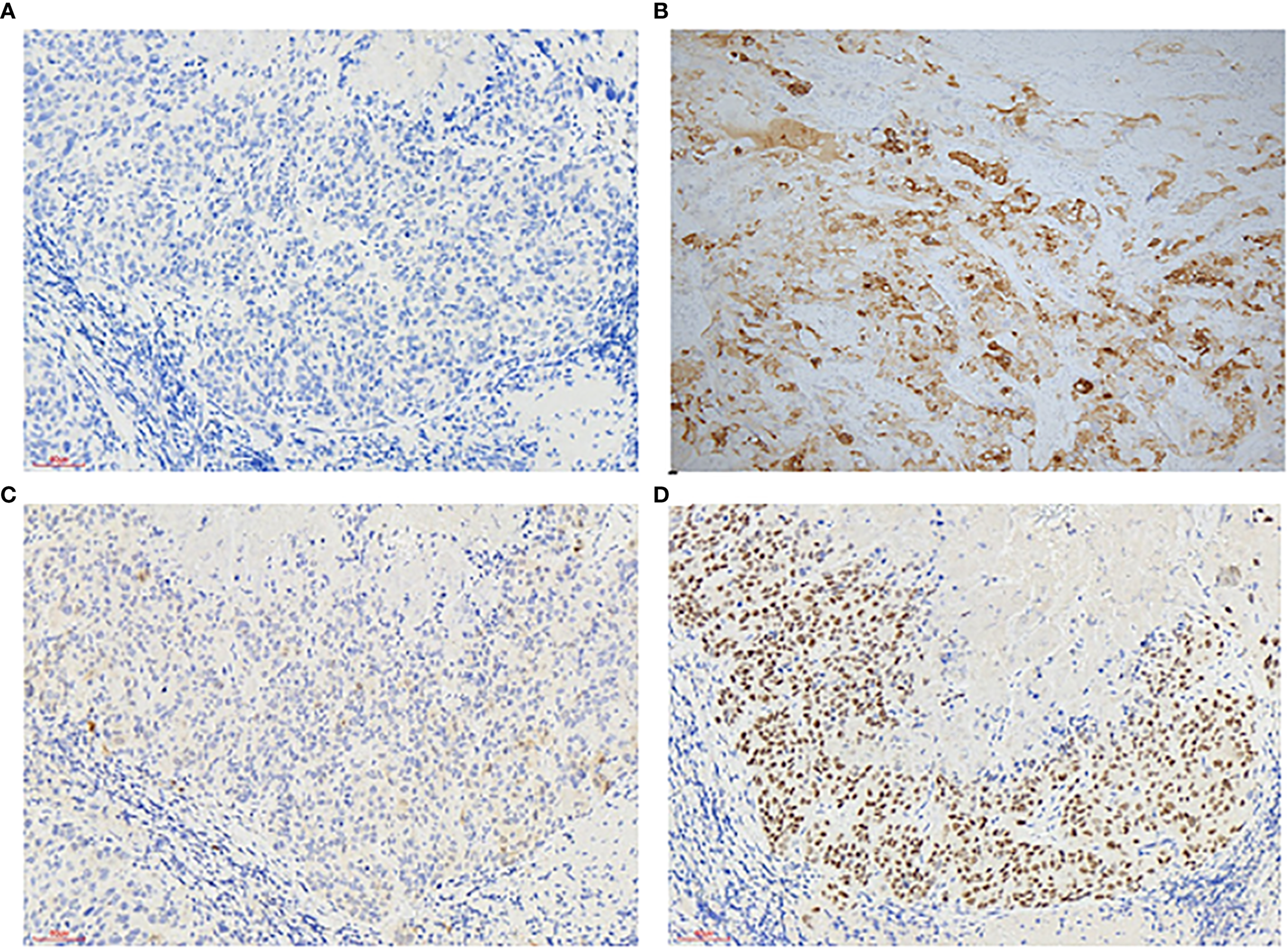 Four microscopy images labeled A, B, C, and D show tissue samples stained to reveal different cellular details. Image A shows densely packed blue stained cells. Image B has scattered brown staining. Image C appears similar to A with less dense staining. Image D displays concentrated brown-stained nuclei, indicating higher activity or presence of a specific protein.