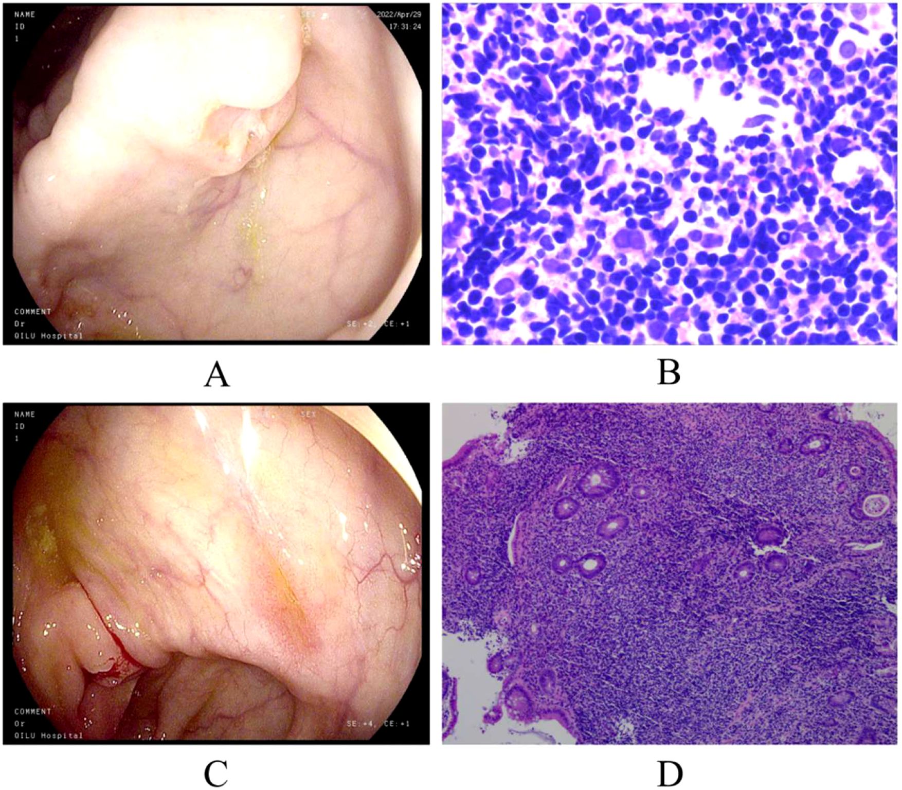 Panel A shows an endoscopic view of the gastric mucosa with visible folds and vascularity. Panel B presents a close-up microscopic image of densely packed cells stained in purple and blue. Panel C depicts another endoscopic view of the gastric lining with distinct vascular patterns. Panel D displays a histological slide showing tissue structure with cellular details in purple hues.