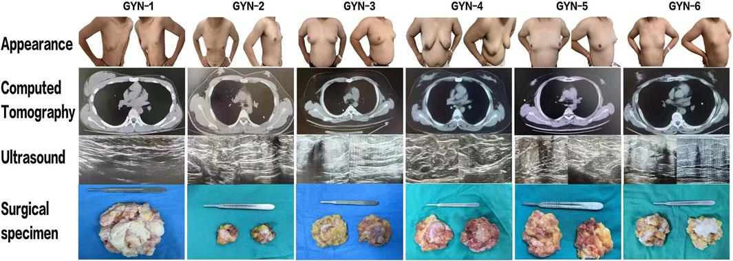 Sequential images of six cases labeled GYN-1 to GYN-6 showing physical appearance, CT scans, ultrasounds, and corresponding surgical specimens. Each column includes a torso image, chest CT image, ultrasound, and surgical specimen on a tray with a scalpel.