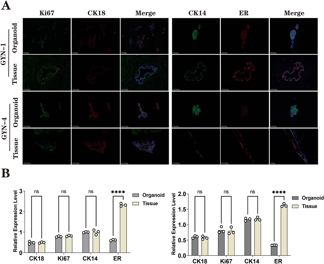 Panel A shows fluorescent microscopy images labeled for Ki67, CK18, CK14, and ER markers from organoid and tissue samples of GYN-1 and GYN-4. The