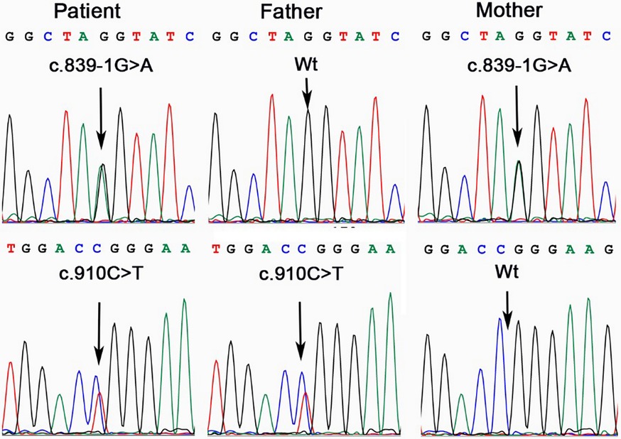 DNA sequencing chromatograms showing genetic variations between a patient and their parents. The patient exhibits variations c.839-1G>A and c.910C>T, while the father only shows c.910C>T, and the mother only shows c.839-1G>A. Arrows indicate mutation locations.