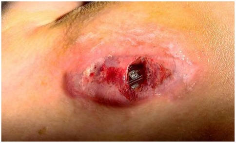 Close-up image of an infected surgical wound with surrounding redness and tissue breakdown. The wound is open, exposing an implanted medical device underneath, with visible inflammation and signs of tissue damage around the site.