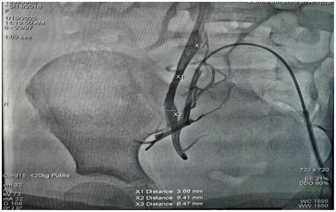 Angiographic image showing contrast injected into the pelvic vessels. A catheter is visible, and vessel lumen measurements are marked at three points: X1 (3.66 mm), X2 (6.41 mm), and X3 (6.47 mm). The contrast outlines the vessel structure, aiding in assessment of vessel diameter and flow.