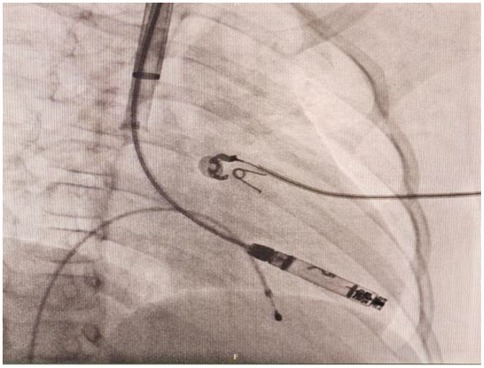 X-ray fluoroscopy image of the chest showing implanted cardiac leads and catheters. The wires are positioned within the heart, and an electrode tip is visible inside a cardiac chamber. Bony structures of the rib cage and spine appear in the background.