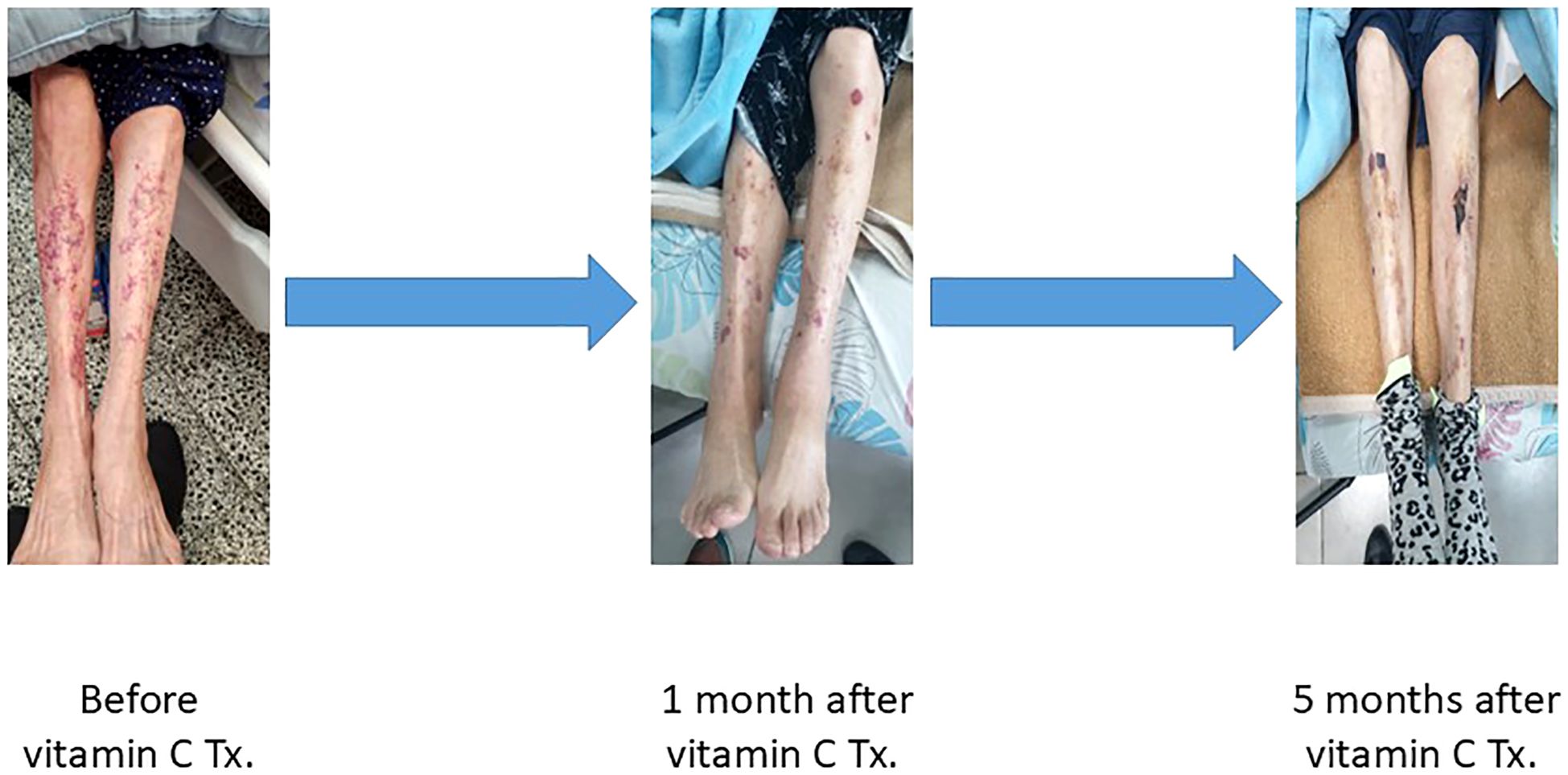Three images show the progression of healing in a person's legs undergoing vitamin C treatment. The first image shows significant skin lesions and discoloration. The second image, one month after treatment, shows reduced lesions. The third image, five months after treatment, shows further healing with minimal remaining marks.