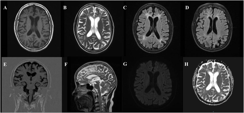 MRI images of a human brain in various views and sequences. Images A to D show axial views highlighting different brain tissues. Image E shows a coronal section, demonstrating symmetrical brain structures. Image F presents a sagittal view, clearly depicting the brain's midline and structures such as the cerebellum. Image G shows a diffusion-weighted image, and Image H provides an apparent diffusion coefficient map. Each image provides different contrasts and details for medical analysis.