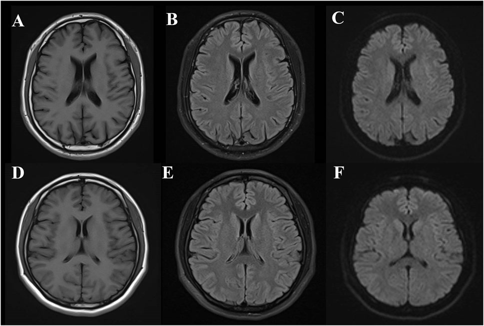 Six MRI brain scans labeled A to F. A and D show T1-weighted images with clear contrast between gray and white matter. B and E are FLAIR images highlighting white matter changes. C and F are diffusion-weighted images emphasizing potential ischemic areas. Each scan shows a transverse section at the level of the lateral ventricles.