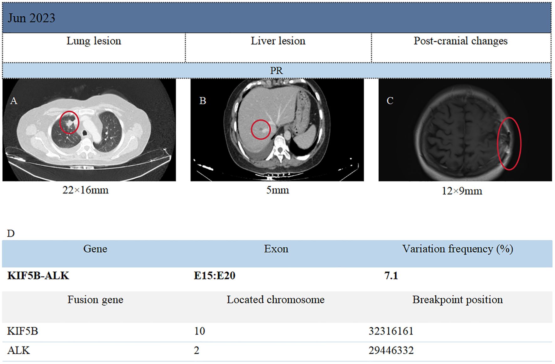 CT and MRI scans showing lesions. Image A shows a lung lesion measuring twenty-two by sixteen millimeters. Image B shows a liver lesion measuring five millimeters. Image C highlights post-cranial changes with a lesion twelve by nine millimeters. Below, genetic information indicates a KIF5B-ALK fusion gene with exon E15:E20, showing a variation frequency of seven point one percent. Information on chromosomes and breakpoint positions are provided for KIF5B and ALK genes.