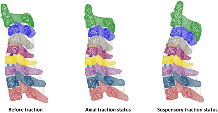 Illustration of a spine in three states: before traction, axial traction, and suspensory traction. Each state shows the spine's vertebrae in different colors, with visible variations in alignment and spacing of the vertebrae.