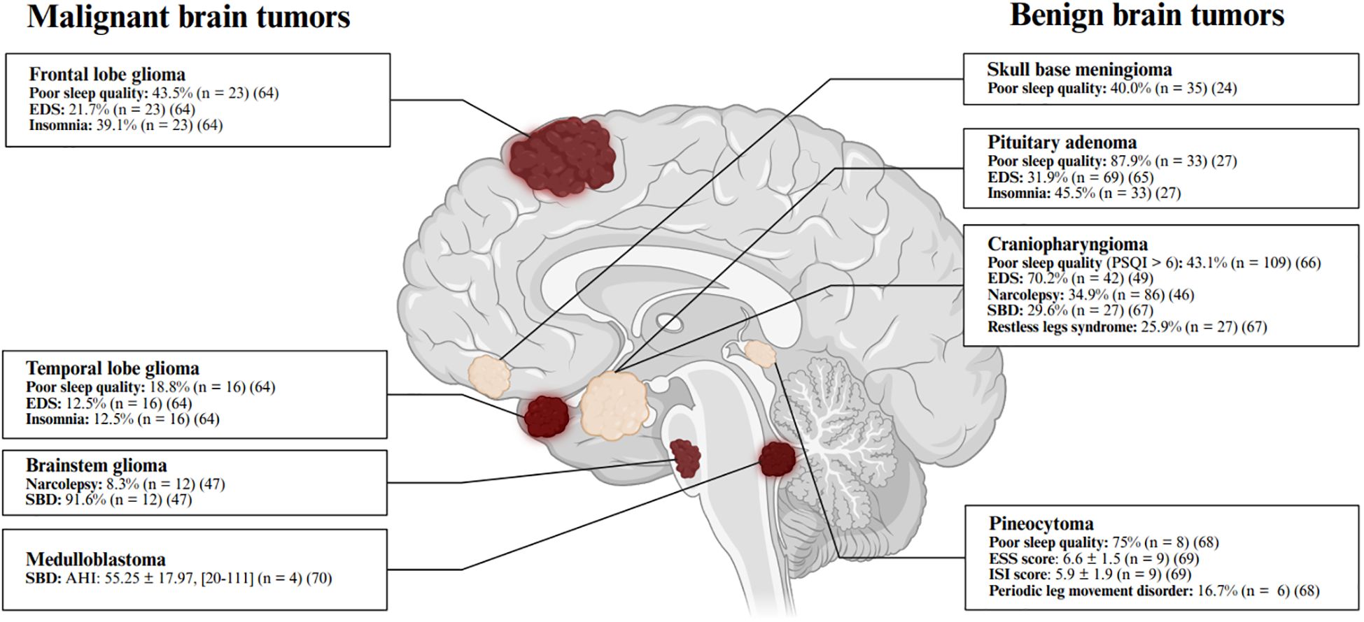 Diagram of a brain showing locations of malignant and benign tumors with associated sleep disorder statistics. Malignant tumors include frontal lobe glioma, temporal lobe glioma, brainstem glioma, and medulloblastoma. Benign tumors include skull base meningioma, pituitary adenoma, craniopharyngioma, and pineocytoma. Each tumor type lists prevalence rates of sleep issues such as poor sleep quality, excessive daytime sleepiness (EDS), insomnia, narcolepsy, and sleep-related breathing disorder (SBD).