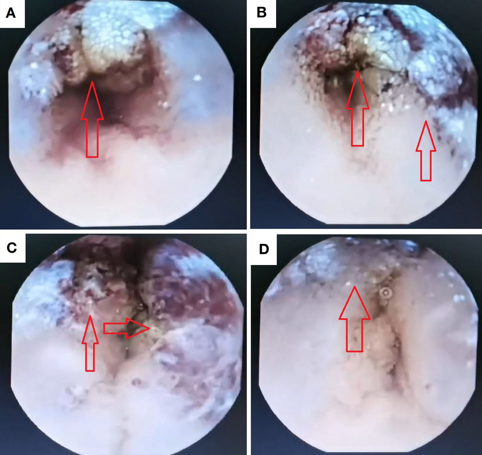 Endoscopic images labeled A, B, C, and D show different views of an internal structure with reddish and white areas. Red arrows point to irregularities or lesions in each view, indicating areas of potential medical interest or concern.