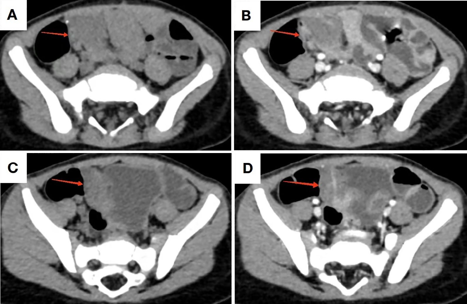 Four-panel CT scan images of the abdomen labeled A to D. Each panel shows a cross-sectional view of the abdominal region with red arrows pointing to a specific area within the gastrointestinal tract.