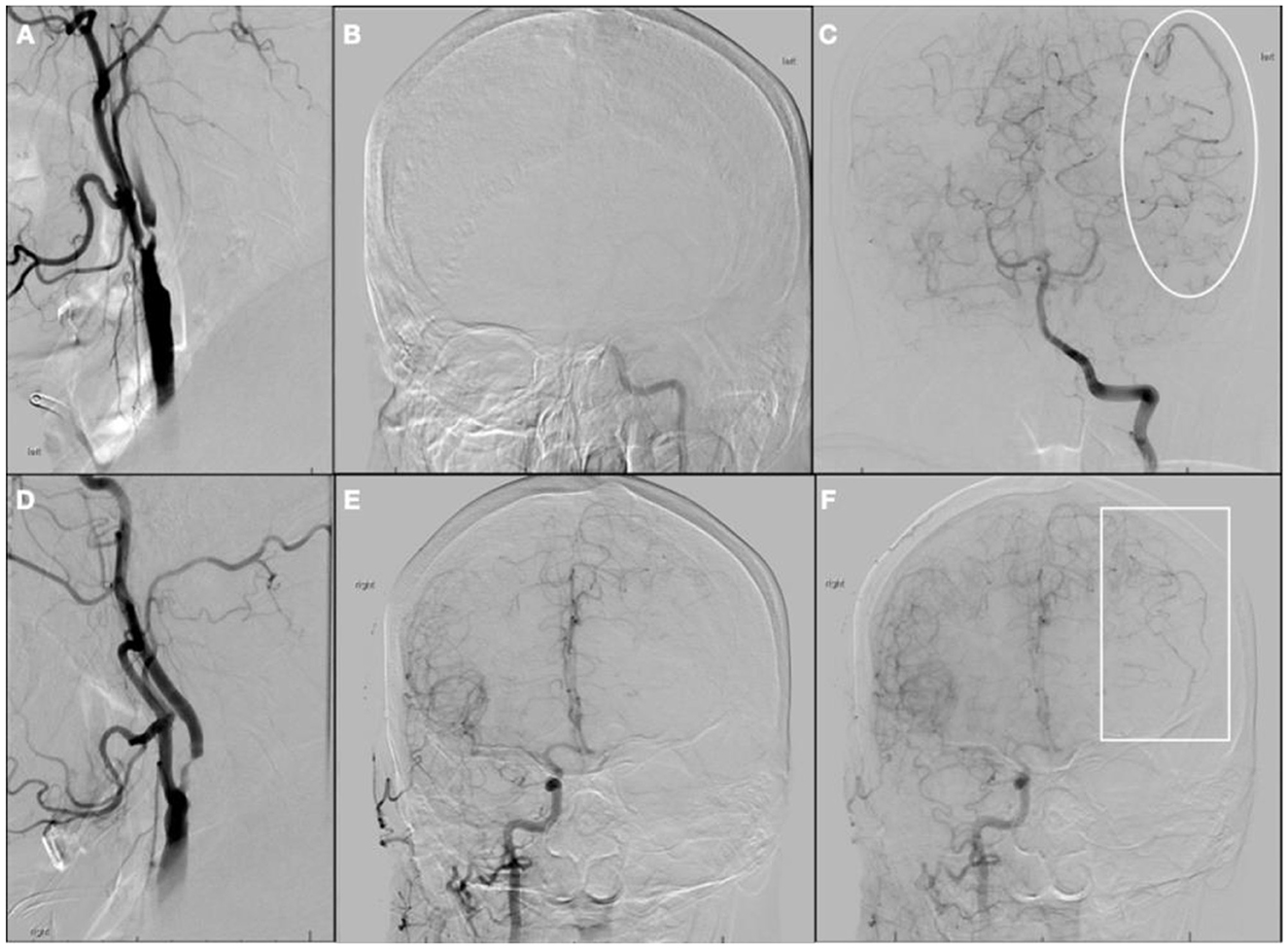 Six-panel medical imaging series showing cerebral angiograms. Panels A and D display images with vascular structures highlighted in black. Panels B and E show faint vessel images of the brain. Panel C highlights a section of intricate vascular structures with an oval. Panel F highlights a rectangular area with faint vessels. The images demonstrate variations in blood flow or vascular detail.