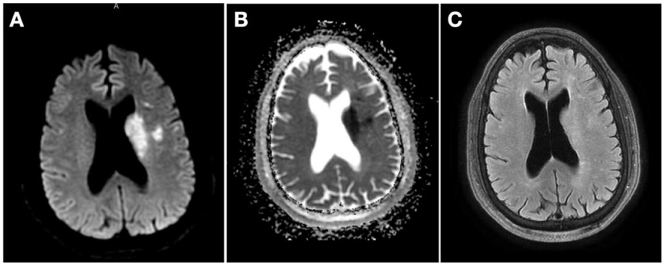 Medical imaging collage showing cerebral angiograms and brain scans. Panels A to E display angiograms of cerebral arteries, highlighting different stages or sections, some with highlighted areas of interest. Panel F includes multiple brain scan slices, with color coding indicating areas of blood flow or volume, and annotated texts showing measurements like rCBF and mismatch volumes.