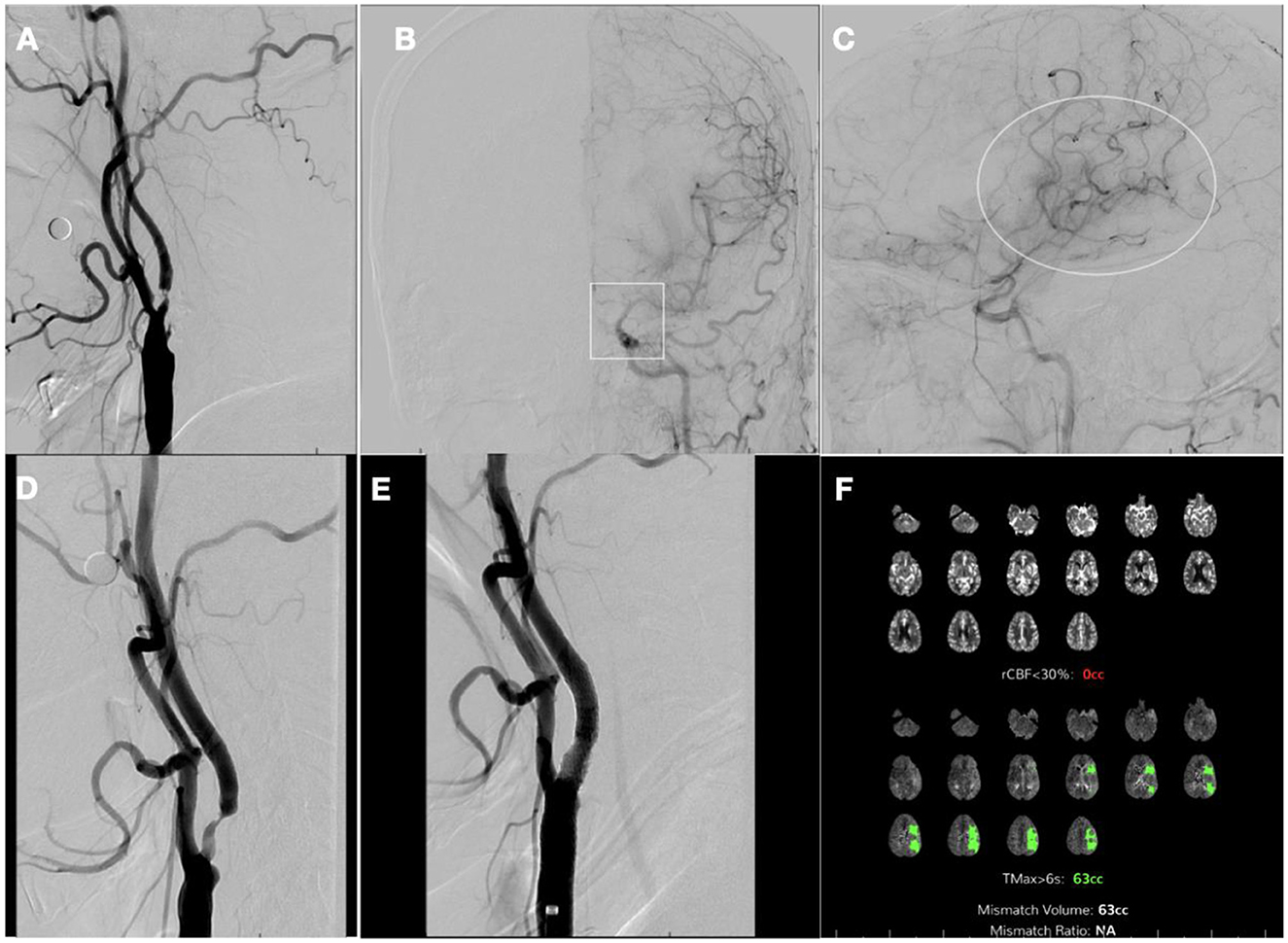 Medical imaging showing three panels. Panel A displays a series of brain scan sections, highlighting areas with reduced cerebral blood flow (rCBF) and Tmax delay with text indicating no detected abnormalities. Panels B and C present comparative angiographic images of cerebral arteries, showing similar vascular structures.