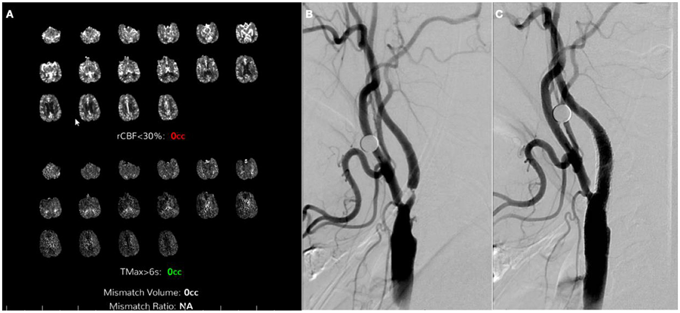 Medical scan illustrating cerebral perfusion and angiography results. The left panel (A) shows multiple brain slices with no critical perfusion deficits, indicated by zero cubic centimeters in red and green text. The right panels (B, C) depict detailed views of cerebral arteries using angiography, highlighting the vascular structures with contrast. These images assess blood flow and potential blockages in the brain, common in stroke evaluations.
