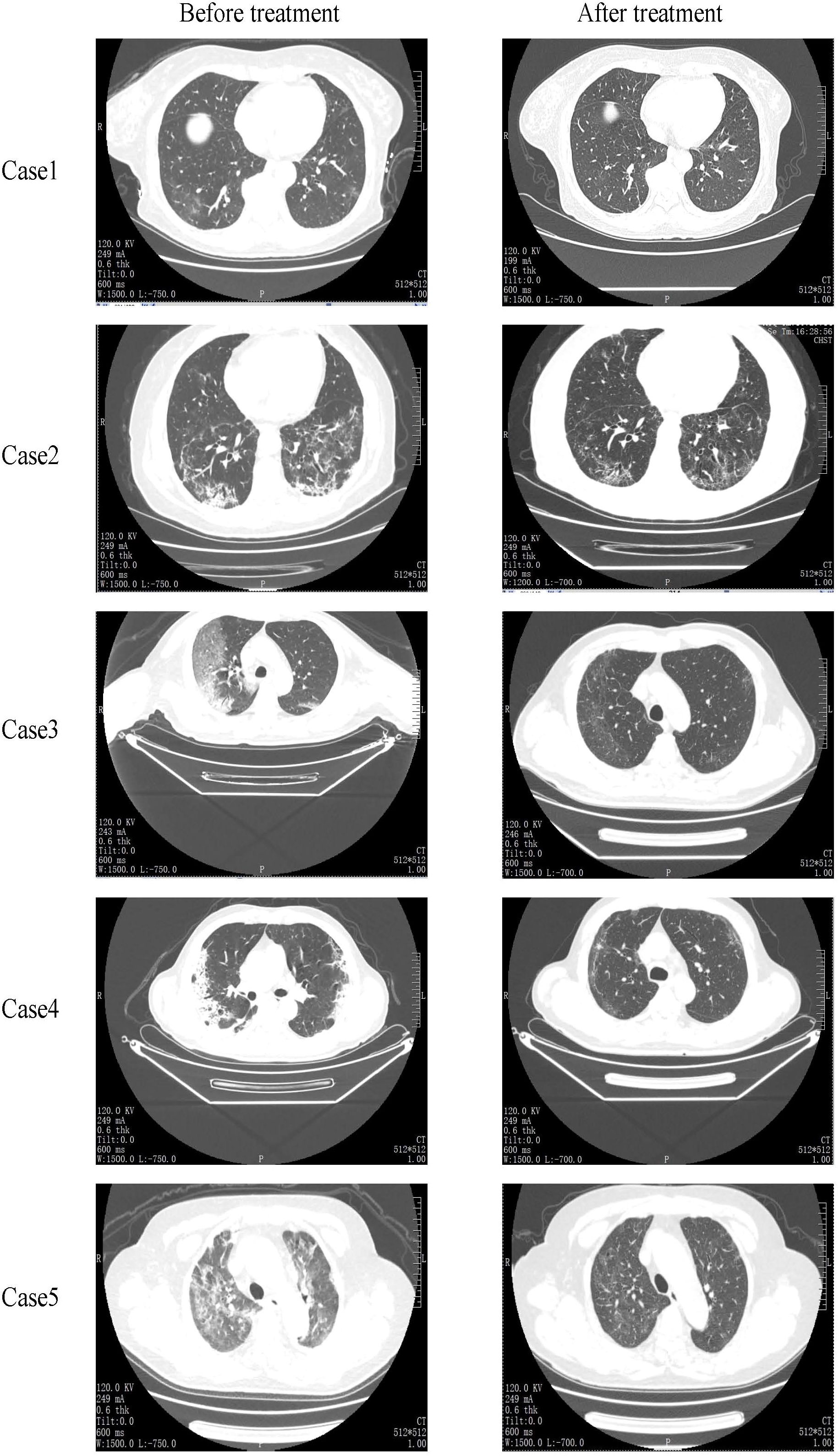 CT scans display lung images from five cases both before and after treatment. The left column shows pre-treatment scans, and the right column shows post-treatment scans. Improvements in lung clarity and reduction of opacities are visible in the post-treatment images for each case.