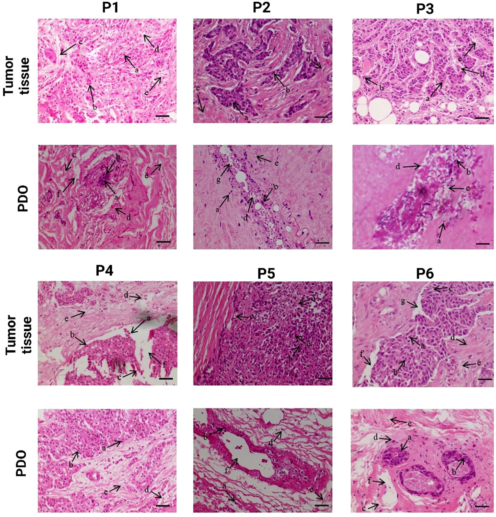 Microscopic images showing tumor tissue and PDO comparisons for six patients (P1 to P6). Each row comprises two images per patient, labeled “Tumor tissue” and “PDO.” Arrows indicate specific structural details, with variations in tissue density and morphology visible across samples. The images display histological differences, such as cellular arrangement and fibrous components, highlighting the comparative analysis of tumor tissue and PDOs.