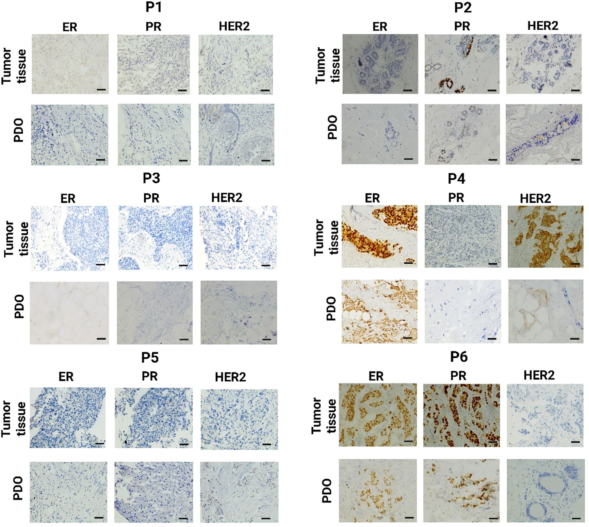 Immunohistochemistry analysis of six patient samples (P1-P6) displaying estrogen receptor (ER), progesterone receptor (PR), and HER2 status. Each sample includes tumor tissue and patient-derived organoids (PDO). ER, PR, and HER2 markers are shown in separate columns, with notable staining variation across samples and tissues, indicating different receptor expressions.