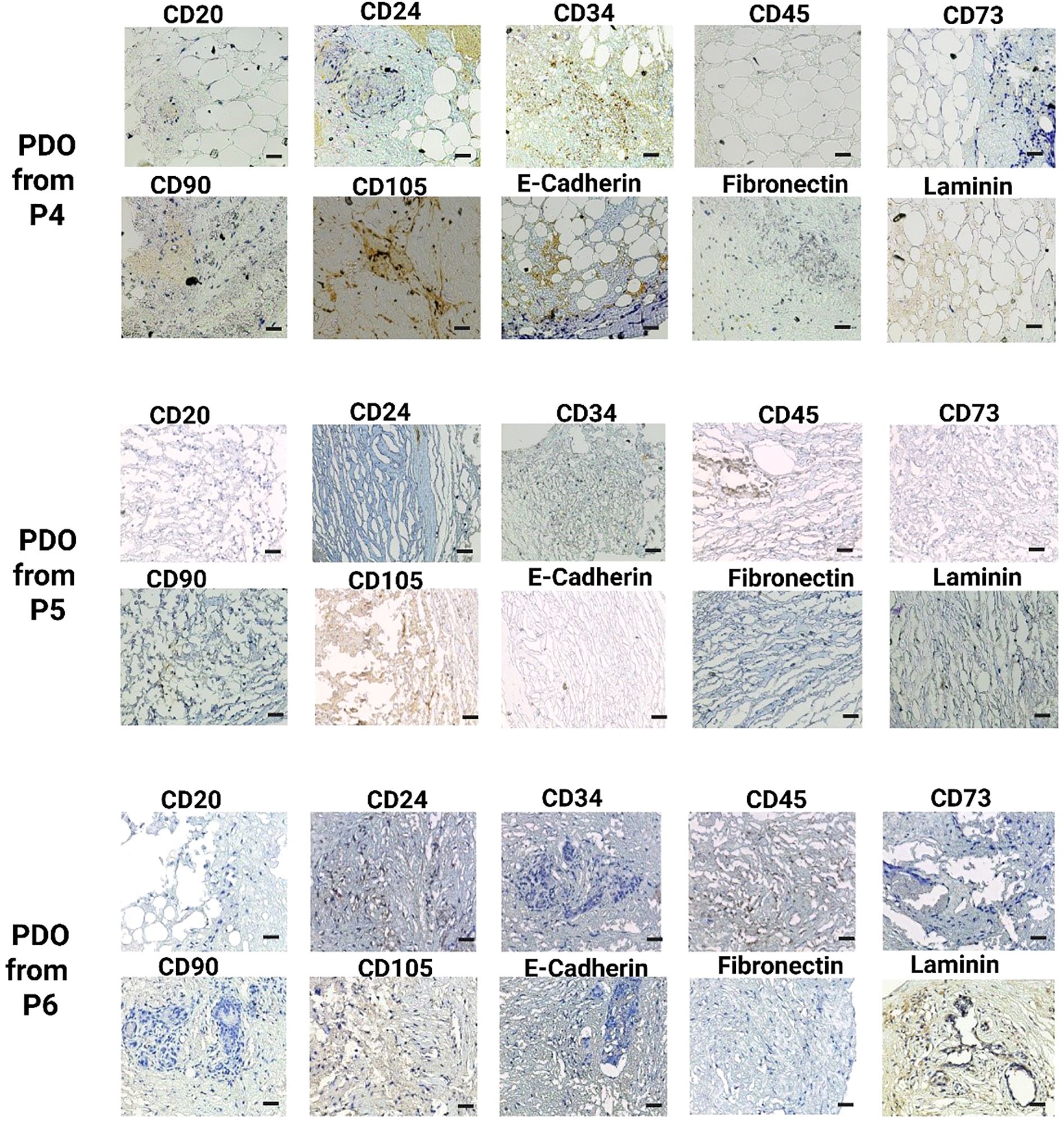 Microscopic images show protein expression in patient-derived organoids (PDO) from three passages (P4, P5, P6). Each row presents markers including CD20, CD24, CD34, CD45, CD73, CD90, CD105, E-Cadherin, Fibronectin, and Laminin. Variations in staining intensity and distribution are visible across passages.