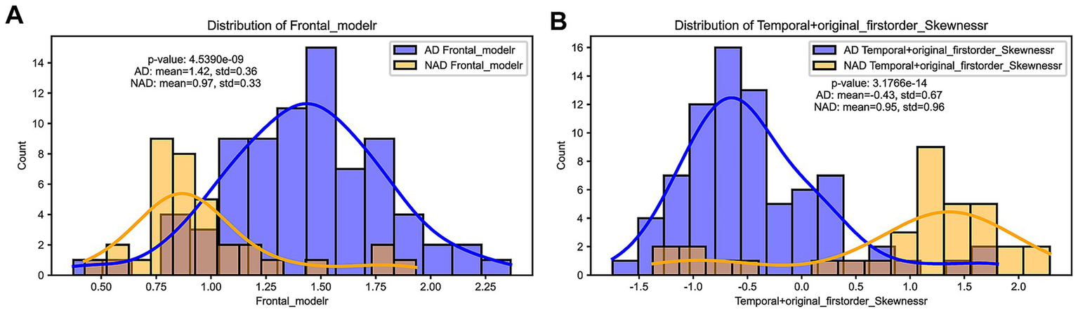 Side-by-side histograms compare two distributions. Panel A shows the distribution of "Frontal_modelr" with separate histograms for AD and NAD groups, including p-value and descriptive statistics. Panel B shows the distribution of "Temporal+original_firstorder_Skewnessr" with similar details. Both feature blue and orange curves and corresponding legends.