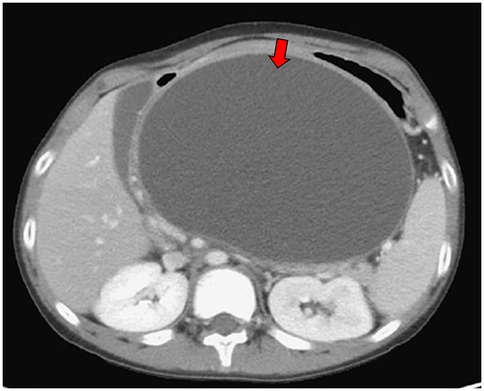CT scan showing a large fluid-filled sac within the abdominal cavity, with a red arrow pointing to its location. The surrounding structures are visible in cross-section.