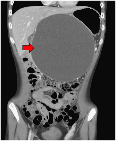 CT scan showing a large, oval mass in the abdominal cavity. A red arrow points to the mass, indicating its significant size and placement. Surrounding structures are visible in cross-section.