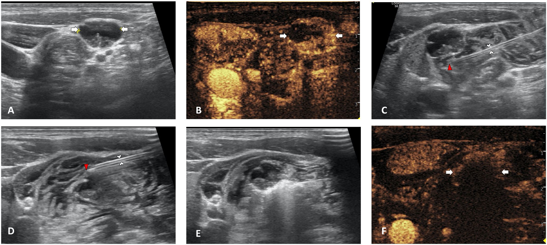 Ultrasound images showing traditional hydrodissection. Image A depicts arrows pointing to hypoechoic LN. Image B highlights inhomogeneous enhanced LN after contrast-enhanced ultrasound (CEUS). Image C and image D features traditional hydrodissection procedure with a red arrowhead pointing the needle tip. Image E presents continuous injection of NS to maintain the thickness of isolating band. Image F uses CEUS showed no enhancement in LN after MWA.