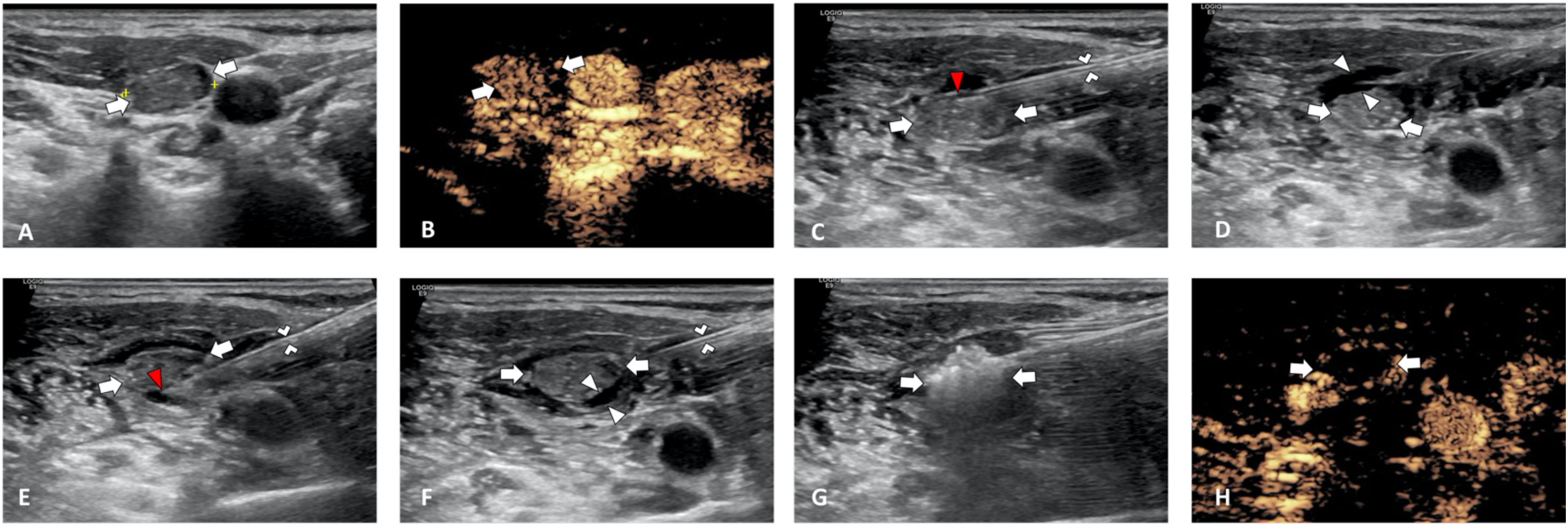 Ultrasound images of improved hydrodissection labeled A to H. Each image shows improved hydrodissection details, highlighted by arrows and indicators. Images B and H represents contrast-enhanced ultrasound (CEUS) of LN Pre-MWA and Post-MWA.