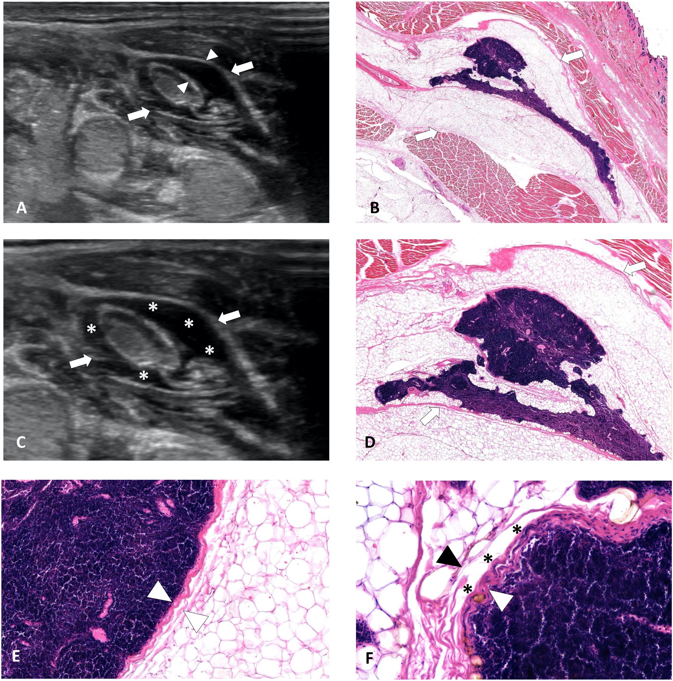 Ultrasound and histological images depicting hydrodissected PLNS. Panel A and C show ultrasound scans with asterisks highlighting the PLNS. Panel B, D, E, and F display histological images, also with asterisks highlighting the PLNS.