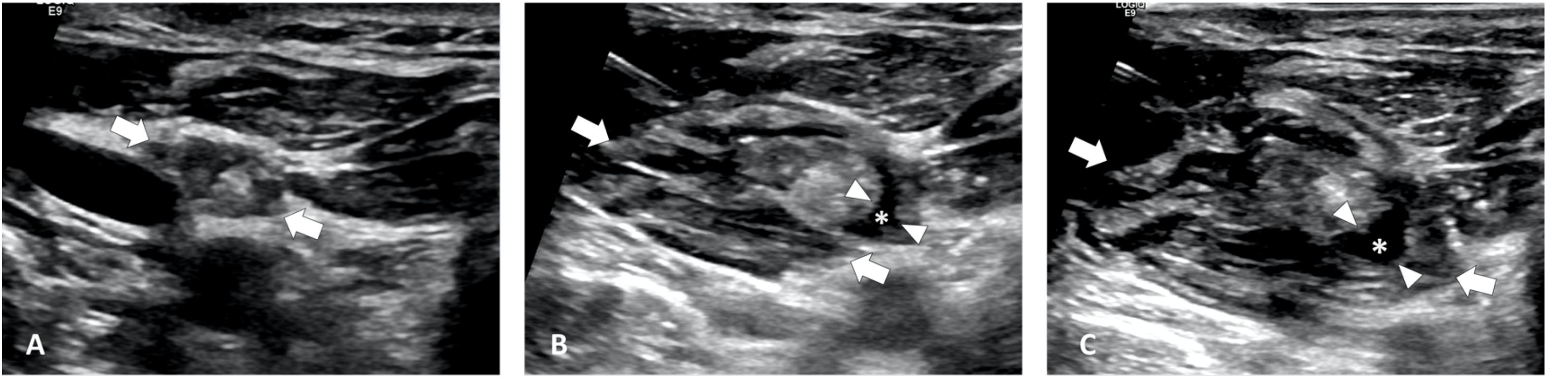 Three ultrasound images of continues hydrodissection. In image A, two white arrows point to hypoechoic LN. Image B and image C shows asterisk indicating PLNS under continues injection.