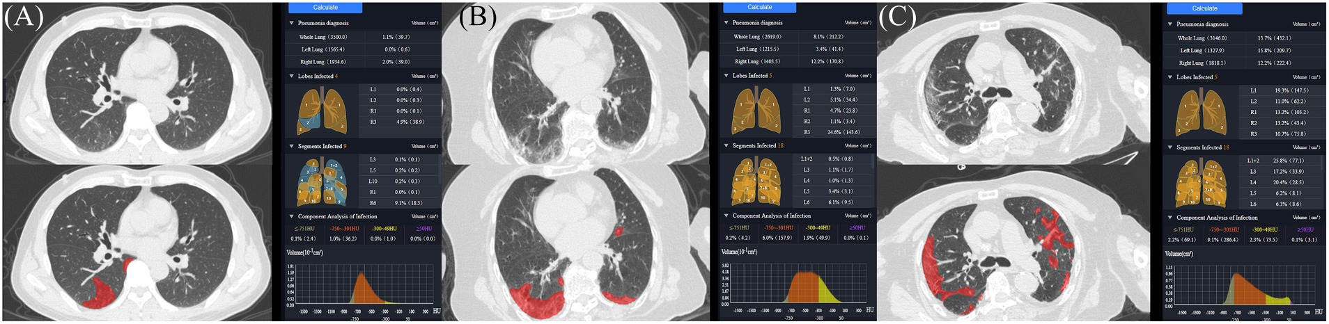 CT scan images labeled A, B, and C display lung sections highlighting areas of pneumonia in red. Adjacent diagnostic charts provide details on infection percentages and volumetric data of infected lung lobes and segments, along with graphs analyzing infection components.