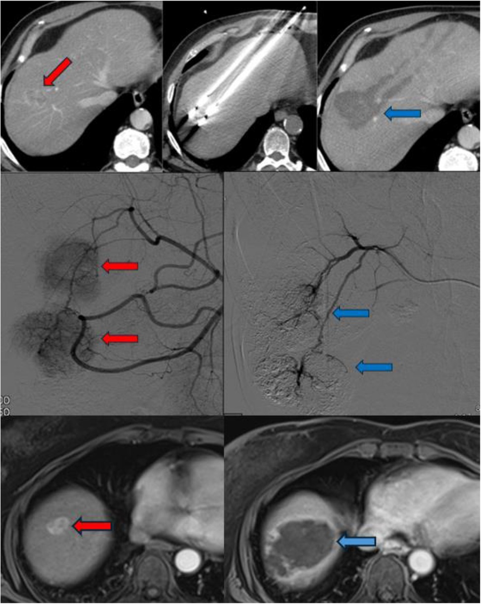 Representative imaging of pretransplant locoregional therapies in HCC. Top row: Contrast-enhanced CT showing an enhancing HCC lesion (red arrow), ablation probe placement, and post-ablation cavity (blue arrow). Middle row: Digital subtraction angiography demonstrating tumor vascularity (red arrows) and post-TACE devascularization (blue arrows). Bottom row: MRI showing viable tumor with contrast uptake (red arrow) and post-TARE necrotic cavity (blue arrow).