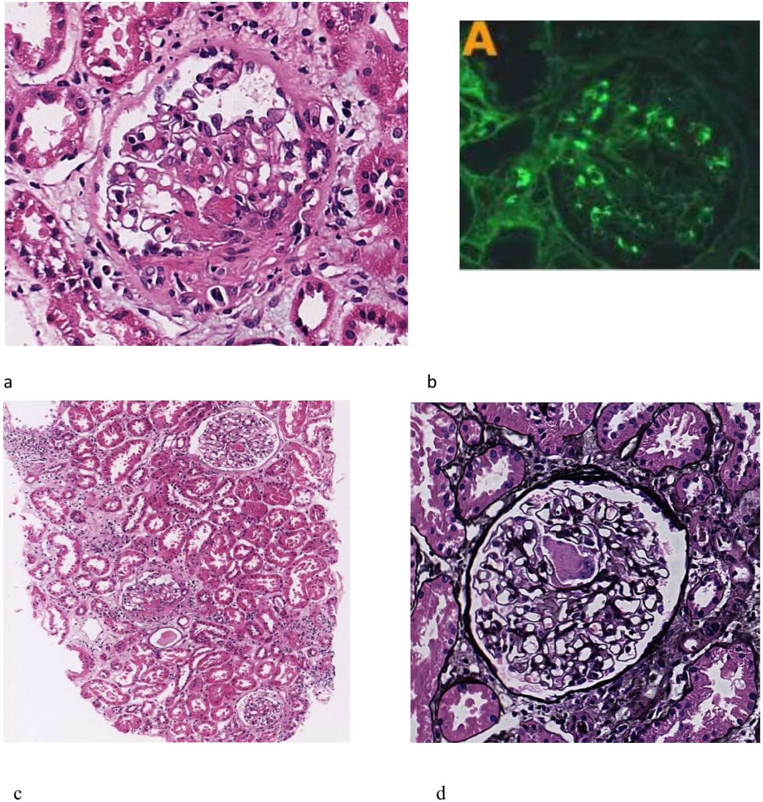 a. Microscopic image of kidney tissue stained with a purple dye, showing cellular structures and a glomerulus. b. Fluorescent microscopic image with bright green highlighting specific structures within kidney tissue. c. Larger section of kidney tissue stained in purple, revealing multiple glomeruli and tubules in a wider field. d. High-resolution image of a kidney glomerulus with dark outlines, showing detailed cellular architecture.