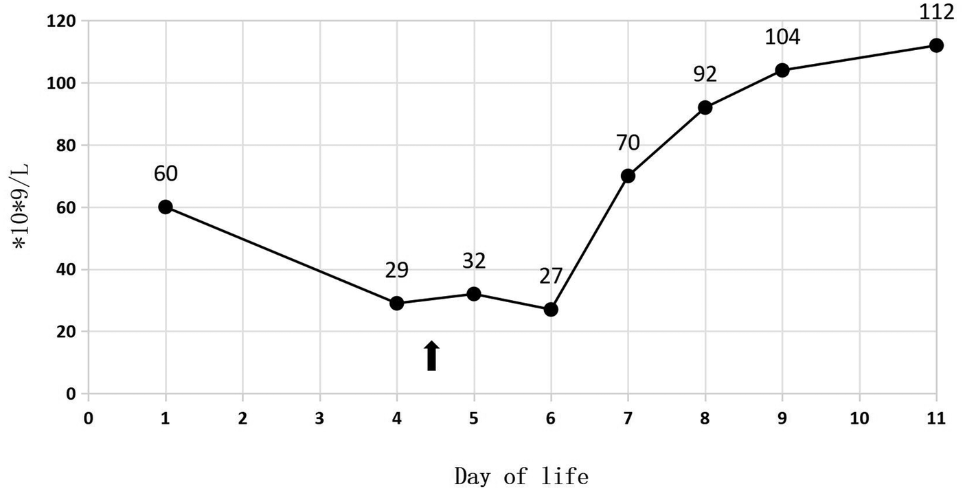 Line graph showing Platelet count over the first eleven days of life, with values decreasing from 60 on day 1 to a low of 27 on day 6, then rising to 112 by day 11. A black arrow under day 4 marks a notable event or intervention.