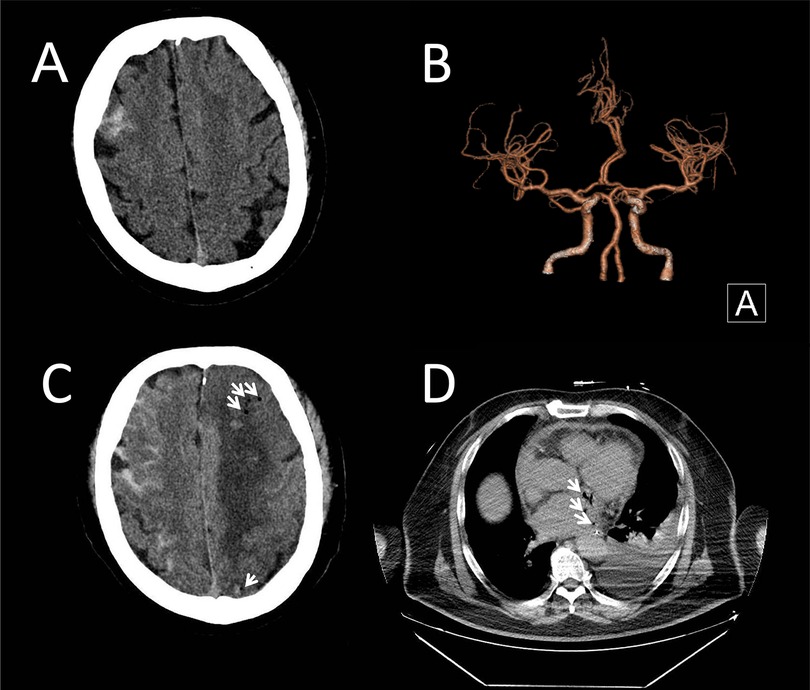 Four medical images labeled A to D. A: CT scan of the brain showing subarachnoid hemorrhage. B: CT scan of the brain with arrows indicating a region of concern. C: 3D reconstruction of cerebral arteries. D: CT scan of the chest displaying the heart and lungs, with arrows pointing to specific areas.