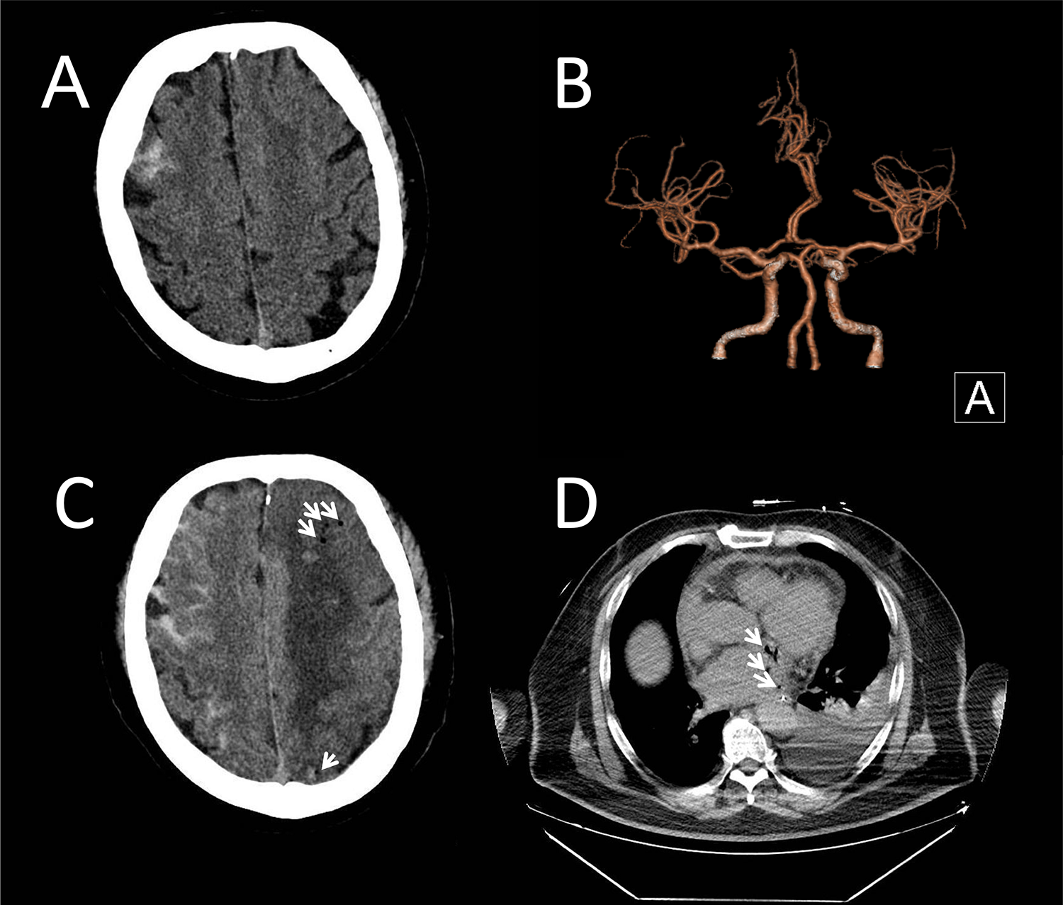 Four medical images labeled A to D. A: CT scan of the brain showing subarachnoid hemorrhage. B: CT scan of the brain with arrows indicating a region of concern. C: 3D reconstruction of cerebral arteries. D: CT scan of the chest displaying the heart and lungs, with arrows pointing to specific areas.