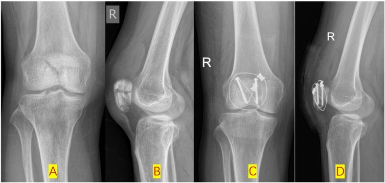 Four-panel X-ray images of a knee joint (A-D). (A) Anterior and (B) lateral views show a transverse patellar fracture. (C) Anterior and (D) lateral views display post-operative fixation using two cannulated screws and a figure-of-eight titanium cable, achieving anatomical reduction and stable fixation.