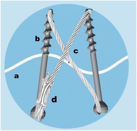 Schematic diagram of the Dual Cannulated Screw-Cable (DCSC) system for patellar fracture fixation. Two half-threaded cannulated screws (b, c) are inserted parallel or non-parallel across the fracture line (a). A titanium cable (c) is passed through the screw cannulas and tensioned in a figure-of-eight pattern, compressing the fracture interface. Label d indicates the cable clamp securing the construct.