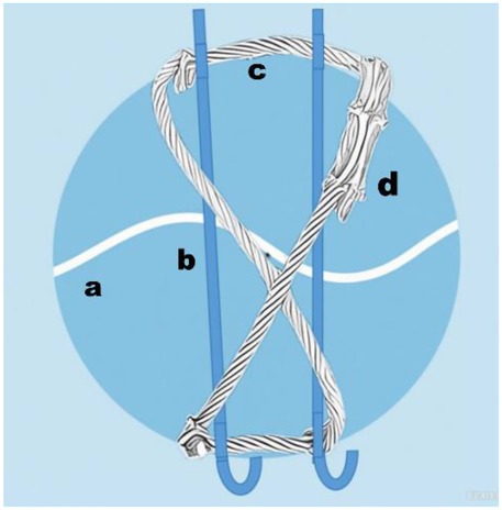 Schematic diagram of the Kirschner Wire-Cable (KWC) tension band system. Two longitudinal K-wires (b) are inserted parallel across the fracture line (a). A titanium cable (c) is woven in a figure-of-eight pattern around the K-wire ends and tightened to compress the fracture. Label d indicates the cable clamp securing the construct.