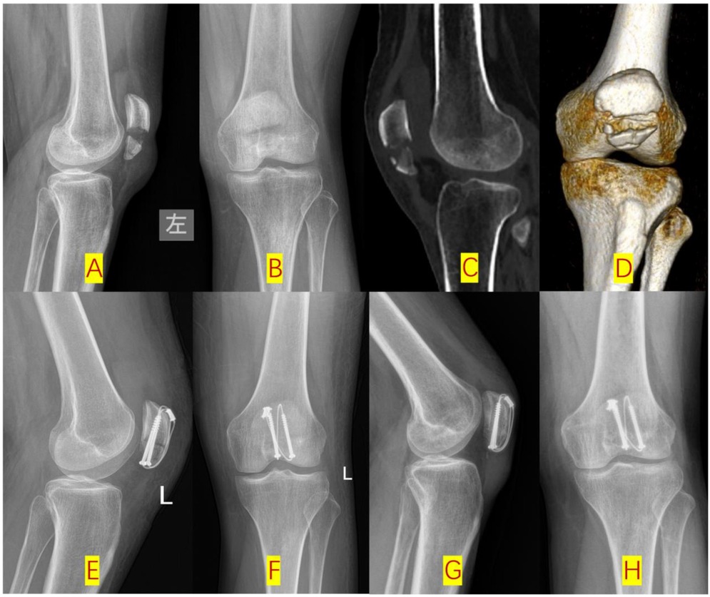 Radiological series of an OTA 34-C2 patellar fracture treated with DCSC. (A-B) Pre-operative X-rays (lateral/anterior) show a comminuted transverse fracture. (C-D) CT scans (sagittal/3D) detail articular displacement and metaphyseal comminution. (E-F) Post-operative X-rays confirm anatomic reduction with cannulated screws and cable. (G-H) 3-month follow-up X-rays show fracture union with maintained alignment.