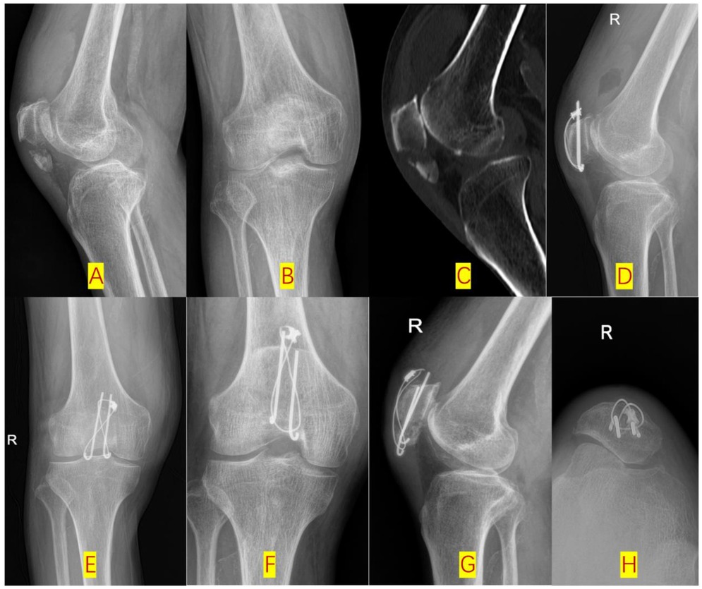 Case series of hardware failure in KWC fixation. (A-B) Pre-operative X-rays show a transverse patellar fracture. (C) CT scan confirms fracture pattern. (D-E) Immediate post-operative X-rays show adequate reduction with K-wires and cable. (F-H) 6-month follow-up X-rays reveal cable detachment and K-wire migration at the proximal pole, though the fracture is united without displacement.