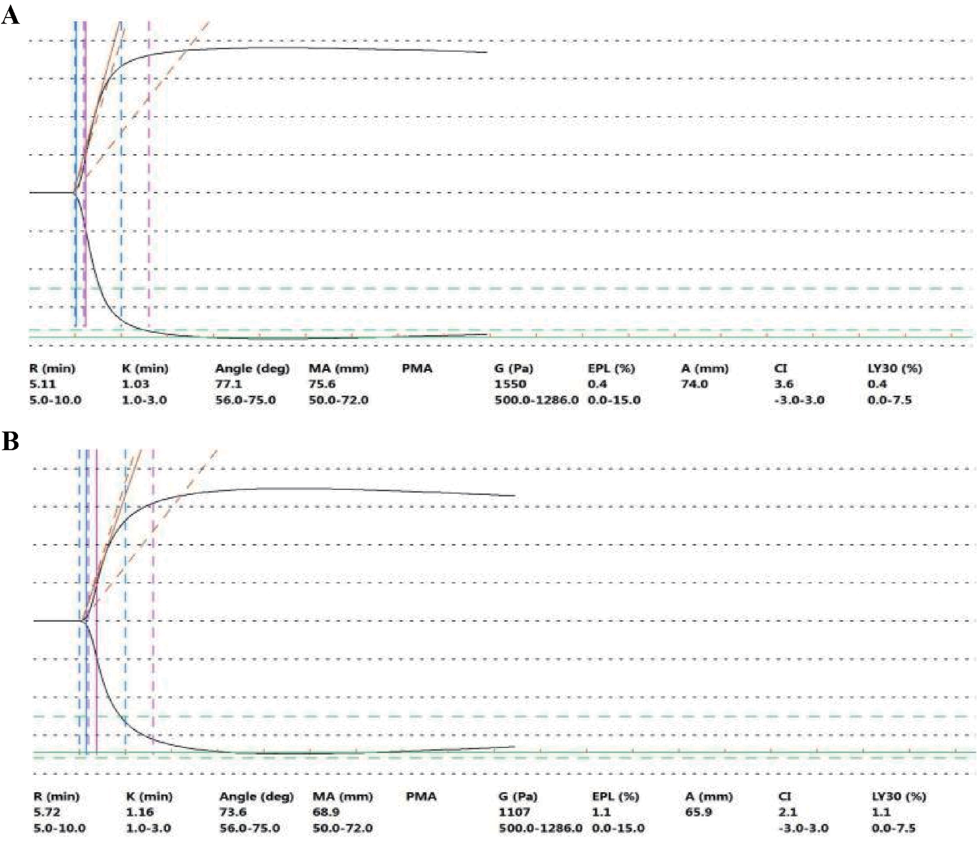 Two graphs labeled A and B display coagulation data with plotted curves. Both graphs feature several parameters: R, K, angle, MA, PMA, G, EPL, A, CI, and LY30, with values provided beneath each graph. Panel A shows slightly higher values for MA and G compared to Panel B. Panel B shows slightly different R, K, angle, and other parameters, indicating variations between the two datasets.
