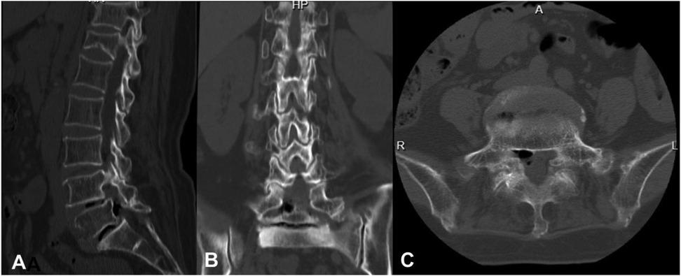 Three-panel CT scan images of the lumbar spine. Panel A shows a sagittal view revealing vertebral alignment and disc spaces. Panel B displays a coronal view highlighting vertebral morphology and symmetry. Panel C presents an axial view at the level of a lumbar vertebra, showing the vertebral body, spinal canal, and surrounding structures.