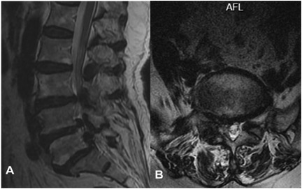 Two-panel MRI of the lumbar spine. Panel A shows a sagittal view depicting vertebral bodies, intervertebral discs, and the spinal cord. Panel B presents an axial view highlighting the spinal canal and nerve roots.